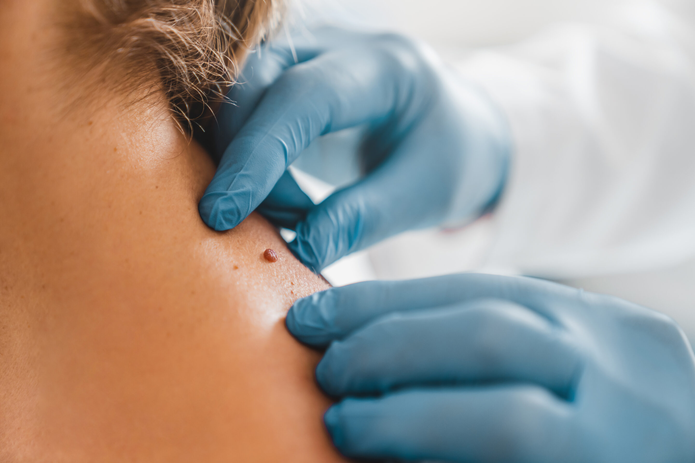 warts on patient's nape