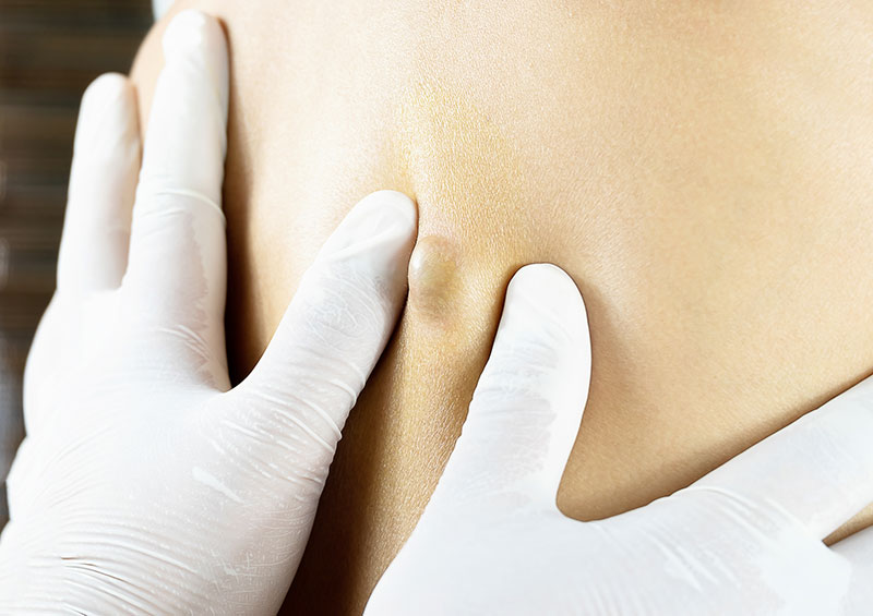 cyst on woman's back
