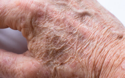 How to Identify Actinic Keratosis: Signs and Symptoms You Should Know